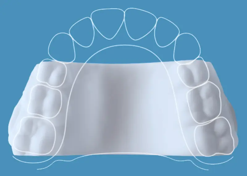 Invisalign Palatal Expander appliance