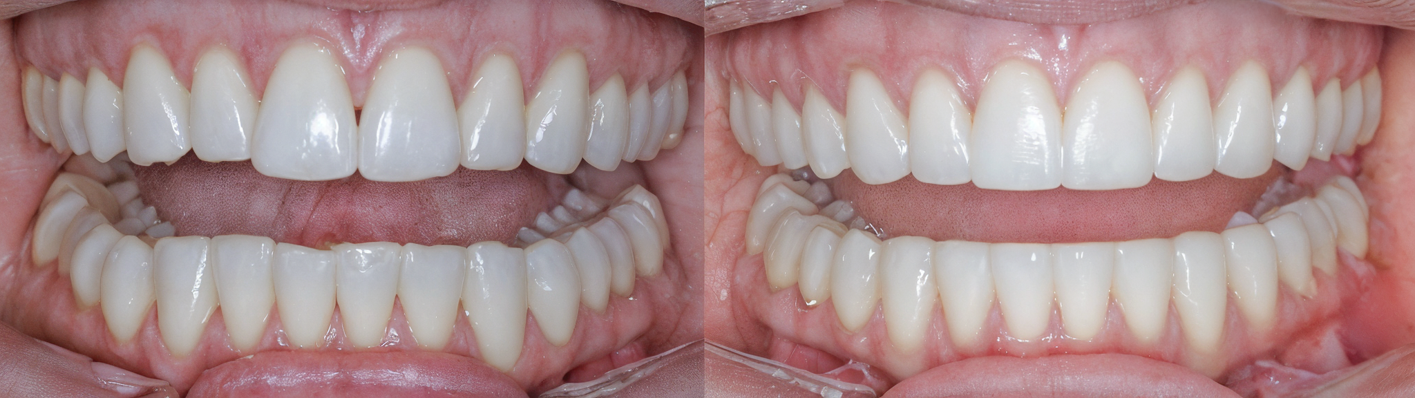 Before and after reshaping teeth closeup