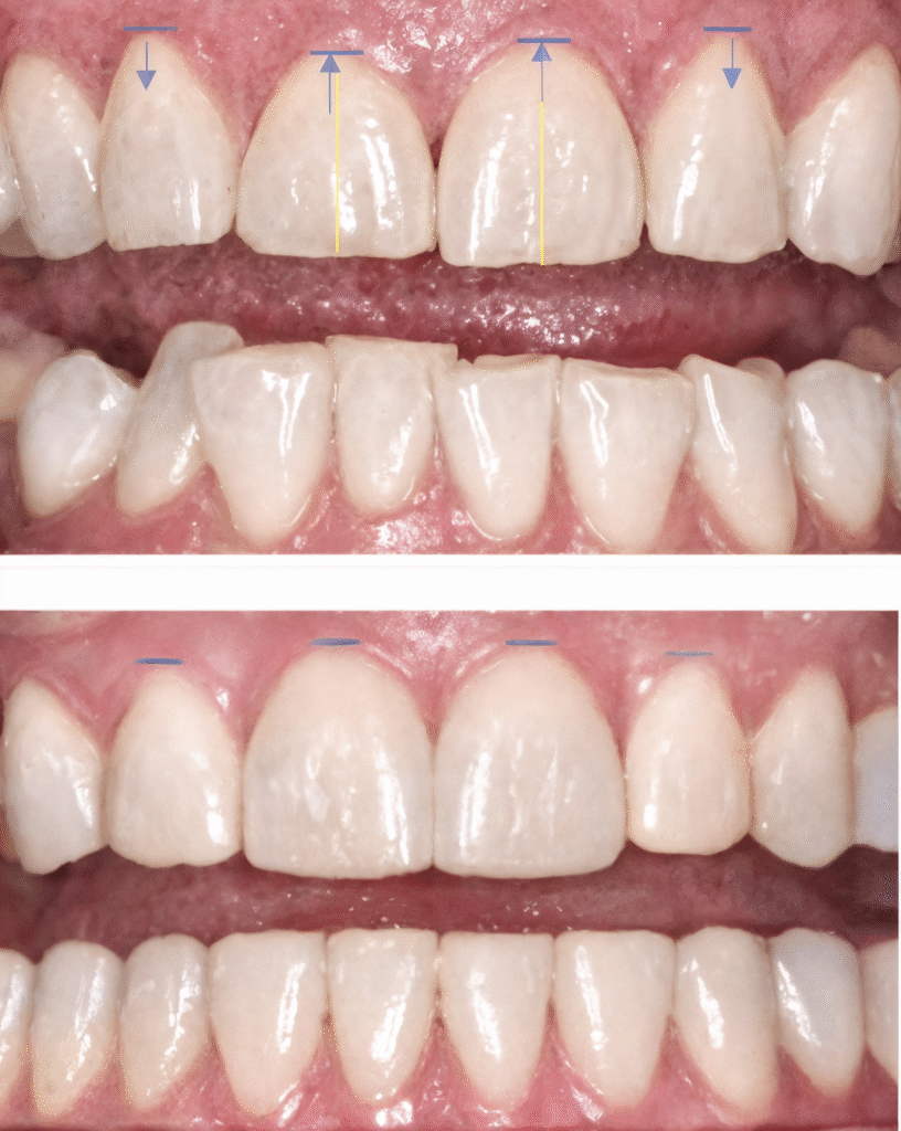 Before and after reshaping teeth closeup