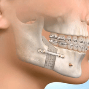 Presurgical-Orthodontics